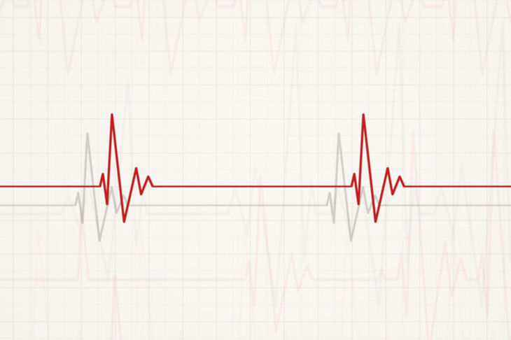 Wykres z badania EKG ukazujący bradykardię