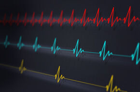 Bradykardia na monitorze