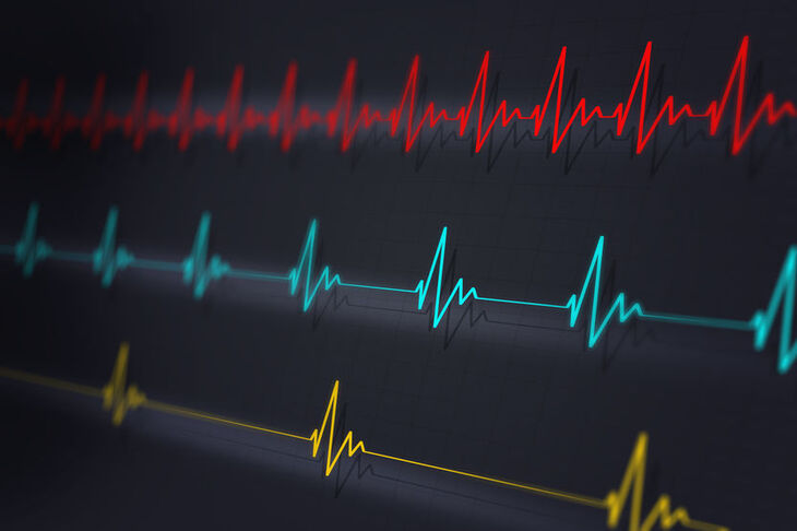 Bradykardia na monitorze