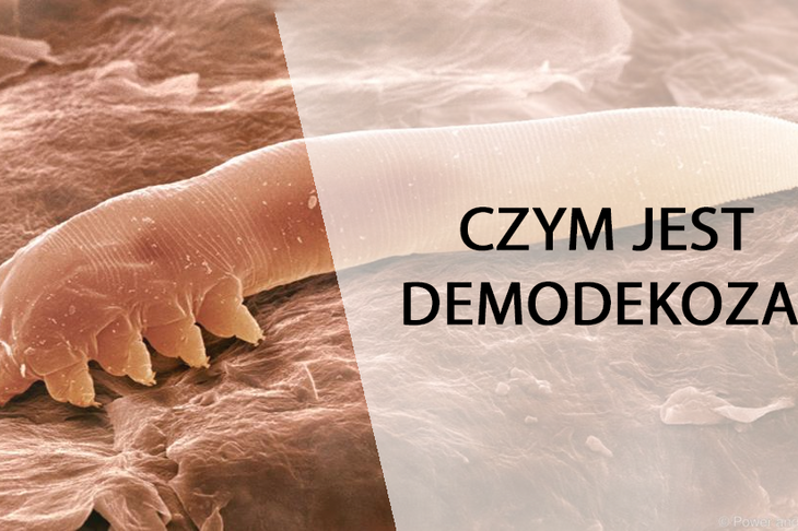 Demodekoza