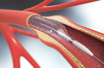 Stent w naczyniu krwionośnym
