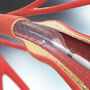 Stent w naczyniu krwionośnym