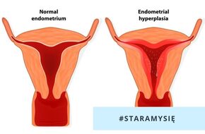 Przerost endometrium