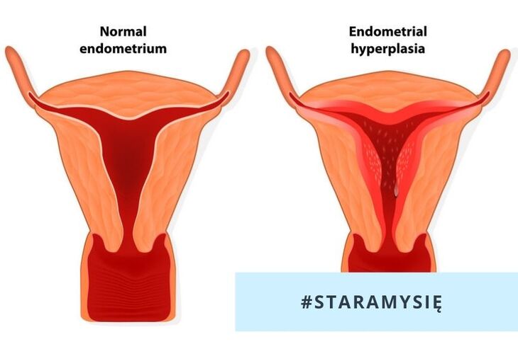 Przerost endometrium