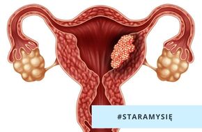 Rak endometrium