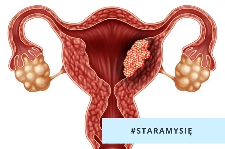 Rak endometrium