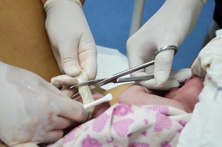Odcinanie pępowiny dwunaczyniowej po narodzinach dziecka