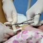 Odcinanie pępowiny dwunaczyniowej po narodzinach dziecka