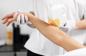 Depilacja włosów na ręku przy pomocy laseroterapii