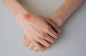 Ganglion na dłoni