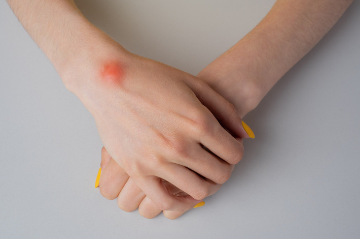 Ganglion na dłoni