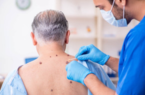 Usuwanie pieprzyków w dermatologa