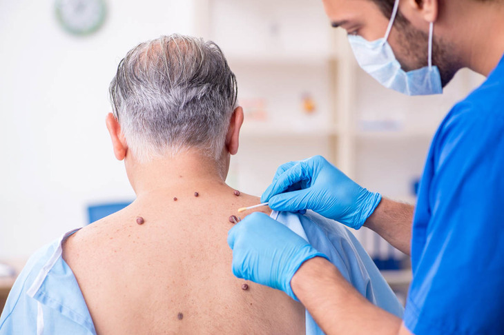 Usuwanie pieprzyków w dermatologa