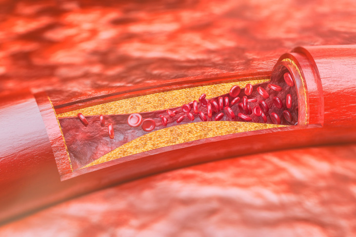 Leczenie wysokiego cholesterolu rozuwastatyną.