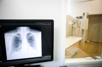 Zdjęcie przedstawia obraz rentgenowski płuc, co sugeruje diagnostykę chorób układu oddechowego, takich jak gruźlica.