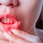 Kobieta z owrzodzoną jamą ustną