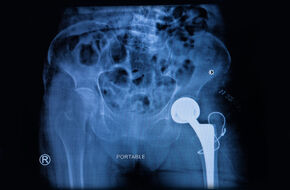 Implant wykonany z biomateriałów