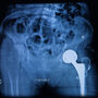 Implant wykonany z biomateriałów