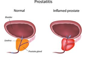 osoba z zapaleniem prostaty