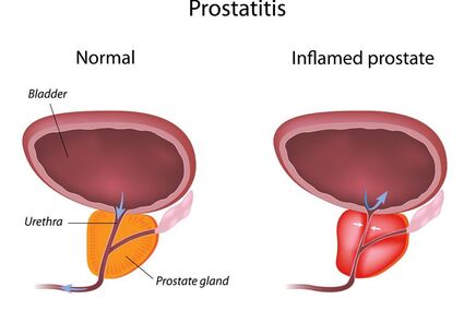 osoba z zapaleniem prostaty