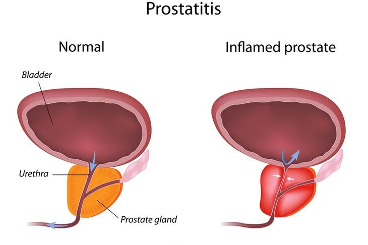osoba z zapaleniem prostaty