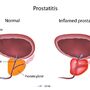 osoba z zapaleniem prostaty