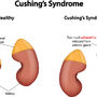 Syndrom zespołu Cushinga
