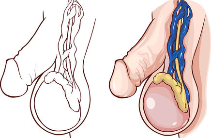 Penis z żylakami powrózka nasiennego