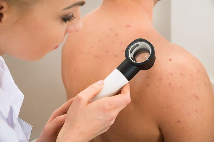 Dermatoskopia