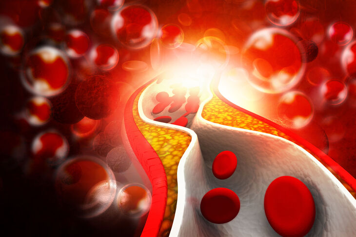 Wysoki cholesterol blokujący przepływ krwi